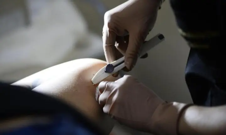 Ministério da Saúde inicia implantação gradual do Implanon no SUS